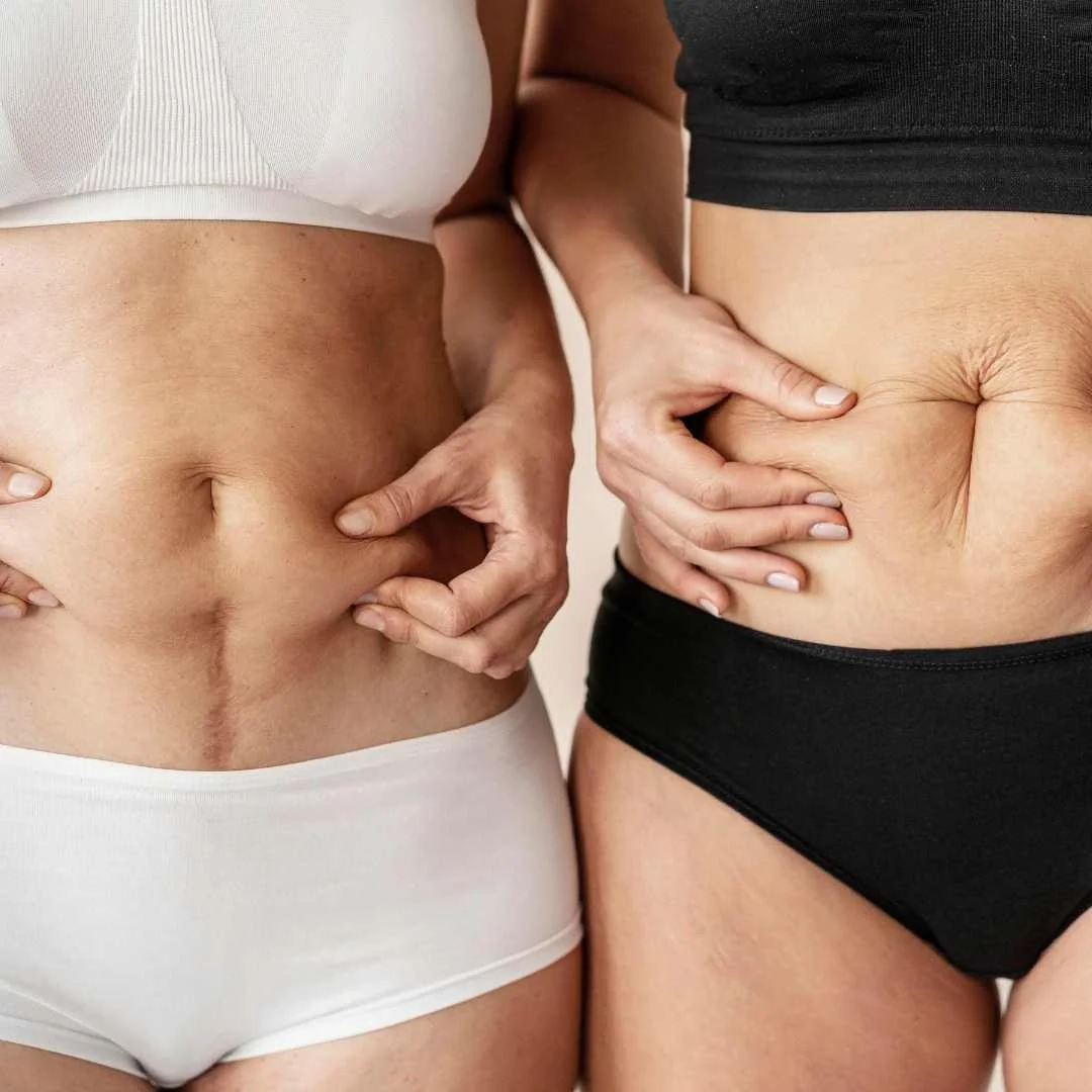 Abdominoplastia candidatas