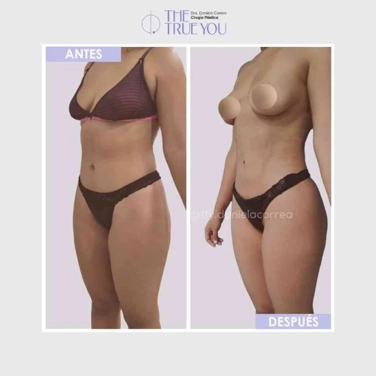 Antes y después 1