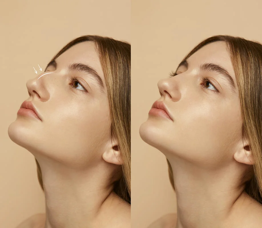 Rinoplastia antes y después